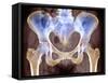 Osteoarthritis of Hip Joints, X-ray-Science Photo Library-Framed Stretched Canvas