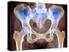 Osteoarthritis of Hip Joints, X-ray-Science Photo Library-Stretched Canvas