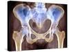 Osteoarthritis of Hip Joints, X-ray-Science Photo Library-Stretched Canvas