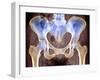 Osteoarthritis of Hip Joints, X-ray-Science Photo Library-Framed Photographic Print