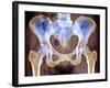 Osteoarthritis of Hip Joints, X-ray-Science Photo Library-Framed Photographic Print