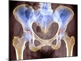 Osteoarthritis of Hip Joints, X-ray-Science Photo Library-Mounted Photographic Print