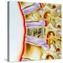 Osteoporitic Spine-John Bavosi-Stretched Canvas