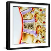 Osteoporitic Spine-John Bavosi-Framed Premium Photographic Print