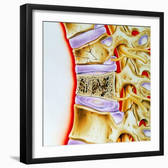 Osteoporitic Spine-John Bavosi-Framed Premium Photographic Print