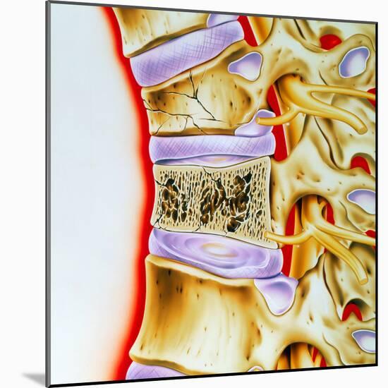 Osteoporitic Spine-John Bavosi-Mounted Premium Photographic Print