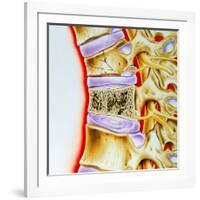 Osteoporitic Spine-John Bavosi-Framed Photographic Print