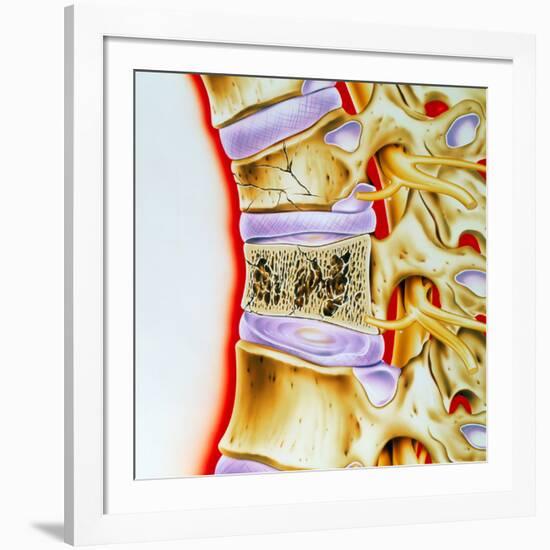 Osteoporitic Spine-John Bavosi-Framed Photographic Print