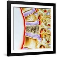 Osteoporitic Spine-John Bavosi-Framed Photographic Print