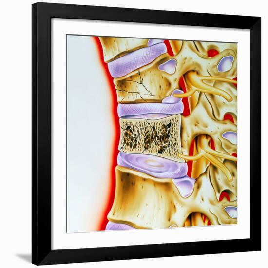 Osteoporitic Spine-John Bavosi-Framed Photographic Print