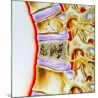 Osteoporitic Spine-John Bavosi-Mounted Photographic Print