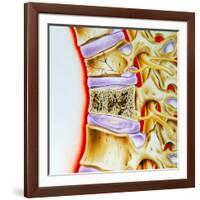 Osteoporitic Spine-John Bavosi-Framed Photographic Print