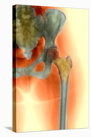 Osteoporosis of the Hip, X-ray-Science Photo Library-Stretched Canvas