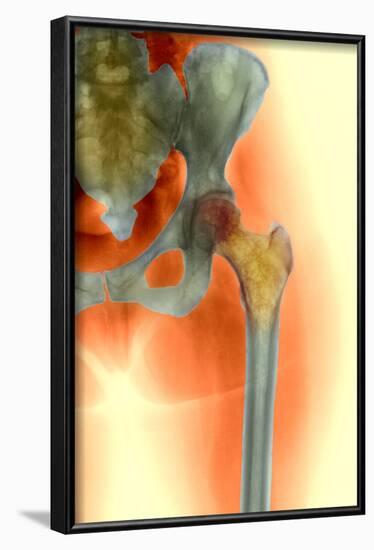 Osteoporosis of the Hip, X-ray-Science Photo Library-Framed Photographic Print