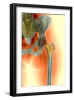 Osteoporosis of the Hip, X-ray-Science Photo Library-Framed Photographic Print
