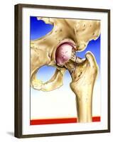 Osteoporosis-John Bavosi-Framed Photographic Print