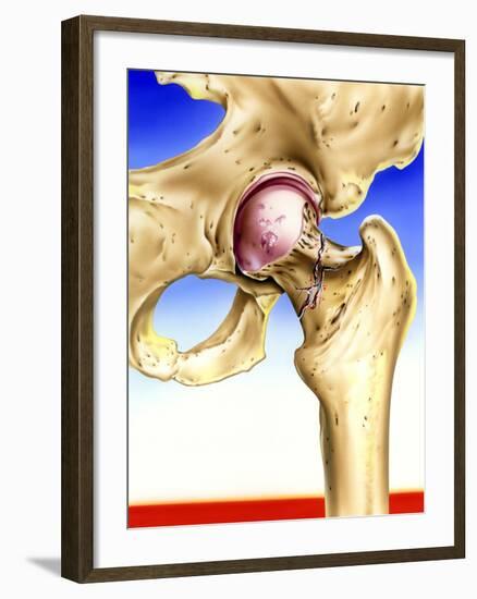 Osteoporosis-John Bavosi-Framed Photographic Print