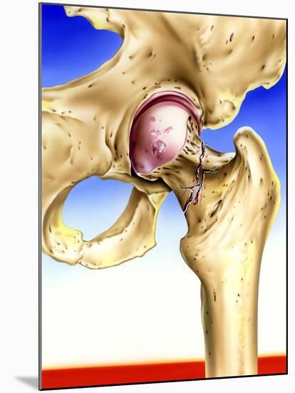 Osteoporosis-John Bavosi-Mounted Photographic Print