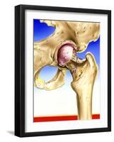 Osteoporosis-John Bavosi-Framed Photographic Print