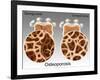Osteoporotic & Normal Bone-Gwen Shockey-Framed Giclee Print