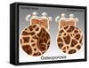 Osteoporotic & Normal Bone-Gwen Shockey-Framed Stretched Canvas