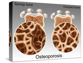 Osteoporotic & Normal Bone-Gwen Shockey-Stretched Canvas