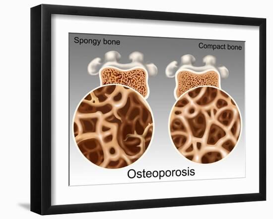 Osteoporotic & Normal Bone-Gwen Shockey-Framed Giclee Print