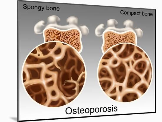 Osteoporotic & Normal Bone-Gwen Shockey-Mounted Giclee Print