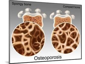 Osteoporotic & Normal Bone-Gwen Shockey-Mounted Giclee Print
