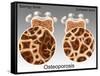 Osteoporotic & Normal Bone-Gwen Shockey-Framed Stretched Canvas