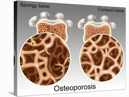 Osteoporotic & Normal Bone-Gwen Shockey-Stretched Canvas