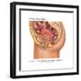 Overflow Incontinence in Female Anatomy-Gwen Shockey-Framed Art Print