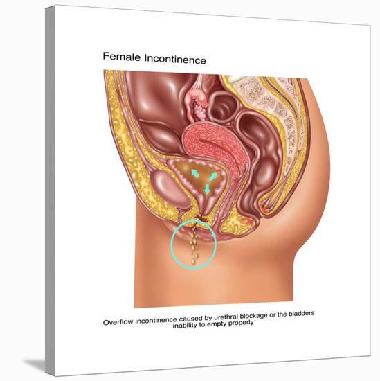 Overflow Incontinence in Female Anatomy-Gwen Shockey-Stretched Canvas