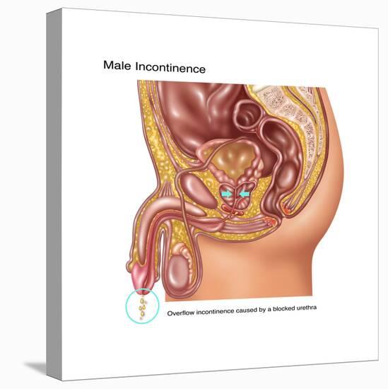 Overflow Incontinence in Male Anatomy-Gwen Shockey-Stretched Canvas