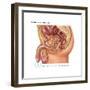 Overflow Incontinence in Male Anatomy-Gwen Shockey-Framed Art Print