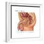 Overflow Incontinence in Male Anatomy-Gwen Shockey-Framed Art Print