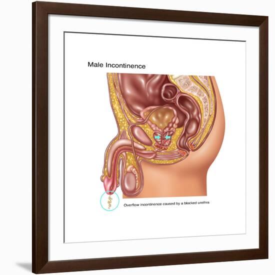 Overflow Incontinence in Male Anatomy-Gwen Shockey-Framed Art Print