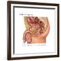 Overflow Incontinence in Male Anatomy-Gwen Shockey-Framed Art Print