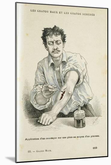 Painting a Wound with an Antiseptic Solution, C1890-null-Mounted Giclee Print