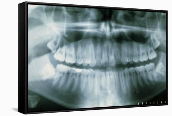 Panoramic Dental X-ray of Impacted Wisdom Teeth-Kaj Svensson-Framed Stretched Canvas