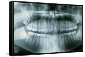 Panoramic Dental X-ray of Impacted Wisdom Teeth-Kaj Svensson-Framed Stretched Canvas