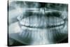 Panoramic Dental X-ray of Impacted Wisdom Teeth-Kaj Svensson-Stretched Canvas