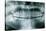 Panoramic Dental X-ray of Impacted Wisdom Teeth-Kaj Svensson-Stretched Canvas