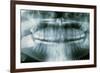 Panoramic Dental X-ray of Impacted Wisdom Teeth-Kaj Svensson-Framed Photographic Print