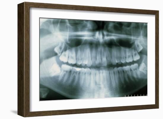 Panoramic Dental X-ray of Impacted Wisdom Teeth-Kaj Svensson-Framed Photographic Print