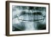 Panoramic Dental X-ray of Impacted Wisdom Teeth-Kaj Svensson-Framed Photographic Print