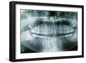 Panoramic Dental X-ray of Impacted Wisdom Teeth-Kaj Svensson-Framed Photographic Print