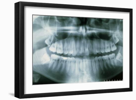 Panoramic Dental X-ray of Impacted Wisdom Teeth-Kaj Svensson-Framed Photographic Print