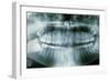 Panoramic Dental X-ray of Impacted Wisdom Teeth-Kaj Svensson-Framed Photographic Print