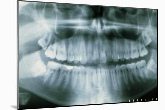 Panoramic Dental X-ray of Impacted Wisdom Teeth-Kaj Svensson-Mounted Photographic Print